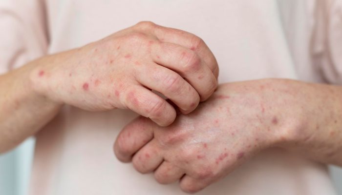 Kasus Campak Meningkat, Pakar Tekankan Pentingnya Vaksinasi