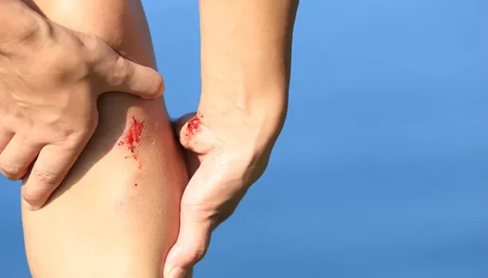 Kasus Hemofilia Tinggi, Baru 13 Persen Terdiagnosis di Indonesia